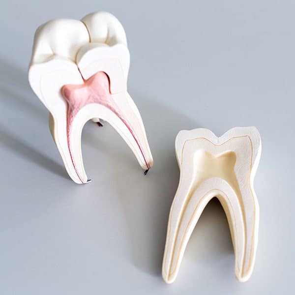 Wurzelspitzenresektion oder Zahn ziehen